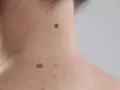 Zbliżenie na skórę szyi i ramienia z widocznymi pieprzykami, w tym jednym ciemniejszym, okrągłym znamieniem reeda.