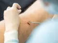Chirurg zszywa ranę po usunięciu pieprzyka. Widoczna jest blizna i narzędzia chirurgiczne.