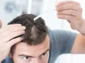 Mężczyzna aplikuje serum na skórę głowy, próbując zaradzić problemowi rzadkich włosów.
