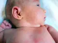 Skóra niemowlęcia z czerwonymi kropkami, widoczne potówki. Szukamy skutecznego sposobu na potówki, by ulżyć maluchowi.
