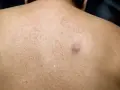 Widoczny pryszcz z krwią na spoconej skórze pleców.