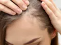 Dłonie kobiety dotykają jej głowy, sprawdzając przerzedzone włosy. Widać delikatne, cienkie włoski, przypominające baby hair, które mogą świadczyć o problemach z wypadaniem włosów.