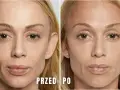 Przed i po zabiegu z użyciem polikaprolakton stymulator. Skóra twarzy wygładzona, z widoczną poprawą objętości i elastyczności.