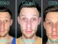 Efekt botoksu na zmarszczki palacza. Czoło mężczyzny dzień po dniu: dzień 1, dzień 4, dzień 7. Zmarszczki stają się mniej widoczne.