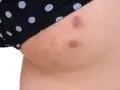 Skóra na udach z widocznymi krostami i przebarwieniami, częściowo zakryta przez czarne majtki w białe kropki.