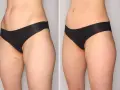 Przed i po zabiegu: widoczna poprawa sylwetki, wygładzenie skóry. Efekty zabiegu "onda" są imponujące.