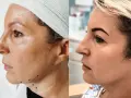 Przed i po zabiegu niciami APTOS: poprawa owalu twarzy i lifting skóry.
