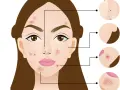Ilustracja twarzy z pryszczami na skroniach, policzkach i nosie. Powiększone fragmenty skóry pokazują różne rodzaje wyprysków.