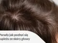 Skóra głowy z widocznym łupieżem. Porady jak pozbyć się łupieżu ze skóry głowy.