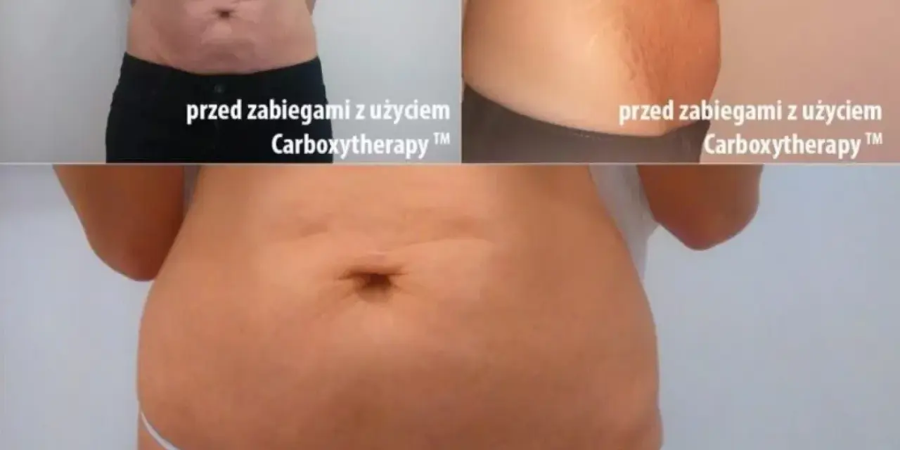 Karboksyterapia efekty: brzuch przed i po 2,5 miesiąca terapii. Widoczna poprawa napięcia skóry i redukcja rozstępów.