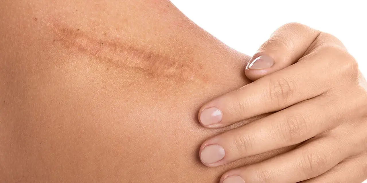 Dermapen na blizny: widoczna blizna na ramieniu, delikatnie dotykana dłonią.