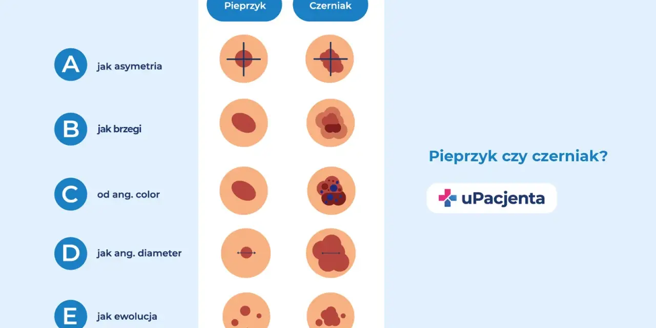 Porównanie pieprzyka i czerniaka: asymetria, brzegi, kolor, średnica i ewolucja. Zwróć uwagę na odstający pieprzyk.
