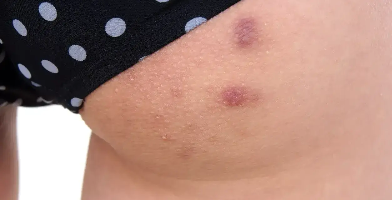 Skóra na udach z widocznymi krostami i przebarwieniami, częściowo zakryta przez czarne majtki w białe kropki.