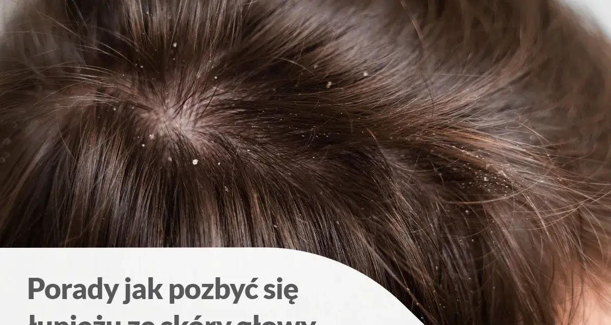 Skóra głowy z widocznym łupieżem. Porady jak pozbyć się łupieżu ze skóry głowy.
