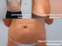 Karboksyterapia efekty: brzuch przed i po 2,5 miesiąca terapii. Widoczna poprawa napięcia skóry i redukcja rozstępów.