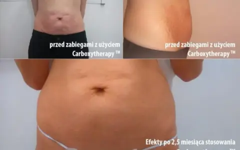 Karboksyterapia efekty: brzuch przed i po 2,5 miesiąca terapii. Widoczna poprawa napięcia skóry i redukcja rozstępów.