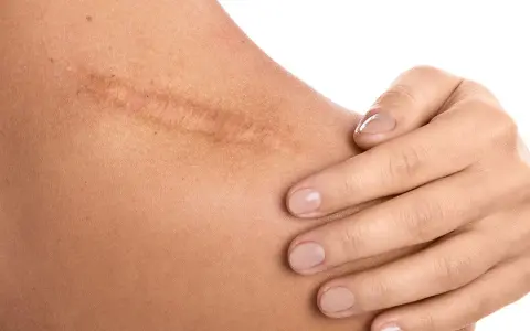 Dermapen na blizny: widoczna blizna na ramieniu, delikatnie dotykana dłonią.