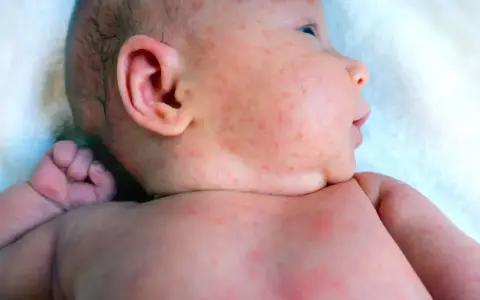Skóra niemowlęcia z czerwonymi kropkami, widoczne potówki. Szukamy skutecznego sposobu na potówki, by ulżyć maluchowi.