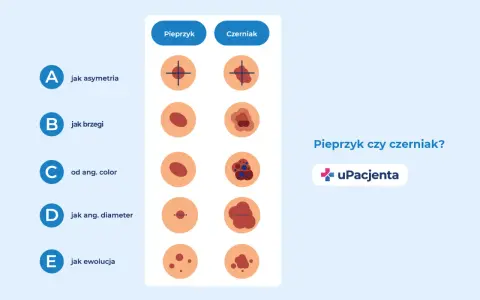 Porównanie pieprzyka i czerniaka: asymetria, brzegi, kolor, średnica i ewolucja. Zwróć uwagę na odstający pieprzyk.