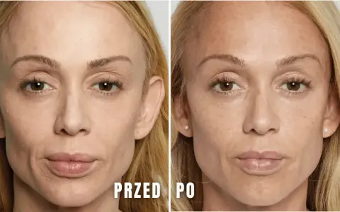 Przed i po zabiegu z użyciem polikaprolakton stymulator. Skóra twarzy wygładzona, z widoczną poprawą objętości i elastyczności.