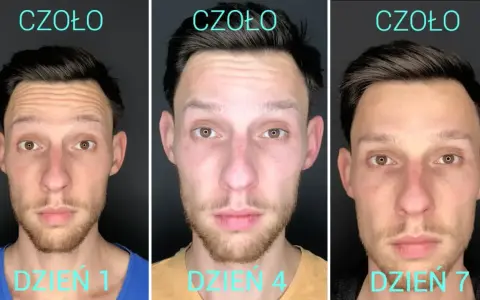 Efekt botoksu na zmarszczki palacza. Czoło mężczyzny dzień po dniu: dzień 1, dzień 4, dzień 7. Zmarszczki stają się mniej widoczne.