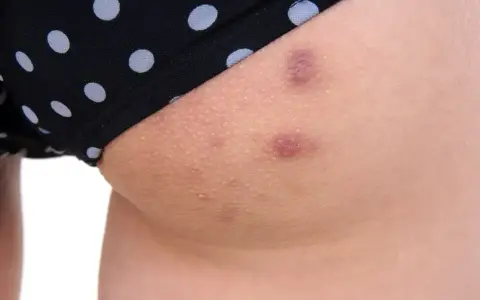 Skóra na udach z widocznymi krostami i przebarwieniami, częściowo zakryta przez czarne majtki w białe kropki.