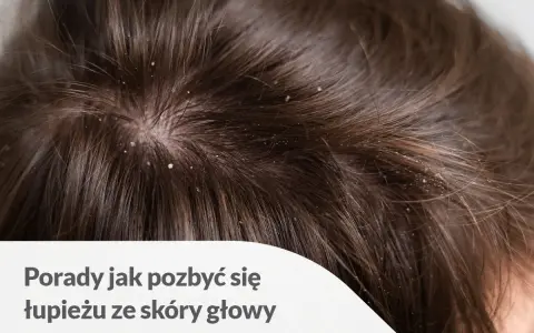 Skóra głowy z widocznym łupieżem. Porady jak pozbyć się łupieżu ze skóry głowy.