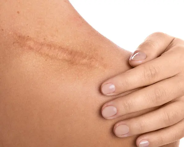 Dermapen na blizny: widoczna blizna na ramieniu, delikatnie dotykana dłonią.