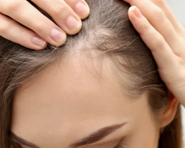 Dłonie kobiety dotykają jej głowy, sprawdzając przerzedzone włosy. Widać delikatne, cienkie włoski, przypominające baby hair, które mogą świadczyć o problemach z wypadaniem włosów.