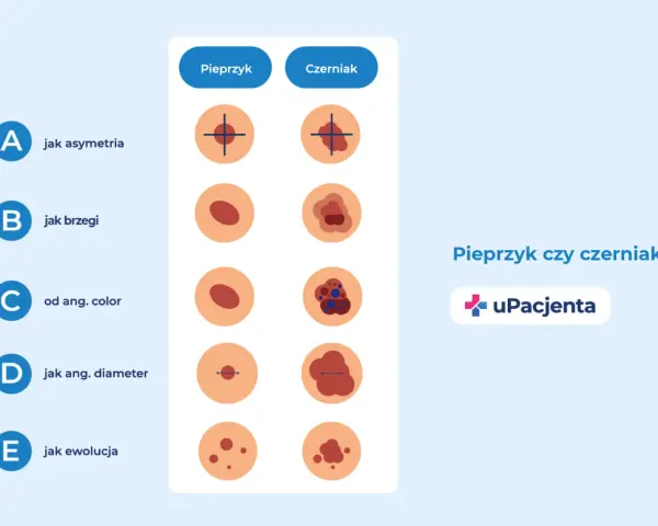 Porównanie pieprzyka i czerniaka: asymetria, brzegi, kolor, średnica i ewolucja. Zwróć uwagę na odstający pieprzyk.