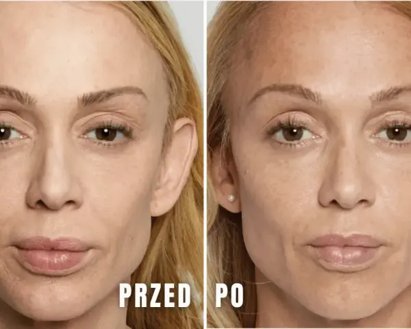 Przed i po zabiegu z użyciem polikaprolakton stymulator. Skóra twarzy wygładzona, z widoczną poprawą objętości i elastyczności.