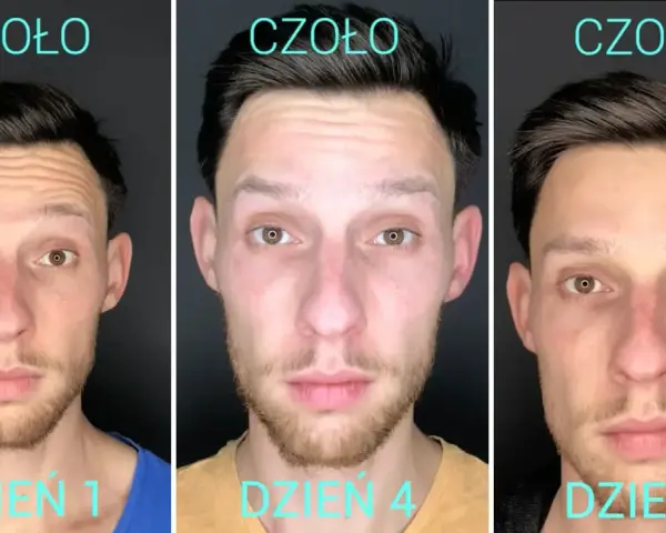 Efekt botoksu na zmarszczki palacza. Czoło mężczyzny dzień po dniu: dzień 1, dzień 4, dzień 7. Zmarszczki stają się mniej widoczne.