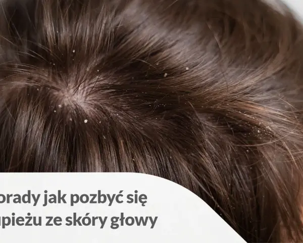 Skóra głowy z widocznym łupieżem. Porady jak pozbyć się łupieżu ze skóry głowy.
