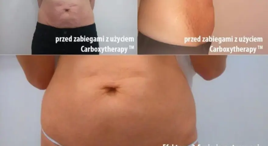 Karboksyterapia efekty: brzuch przed i po 2,5 miesiąca terapii. Widoczna poprawa napięcia skóry i redukcja rozstępów.