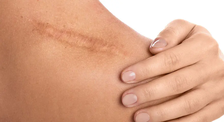 Dermapen na blizny: widoczna blizna na ramieniu, delikatnie dotykana dłonią.