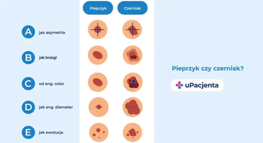 Porównanie pieprzyka i czerniaka: asymetria, brzegi, kolor, średnica i ewolucja. Zwróć uwagę na odstający pieprzyk.