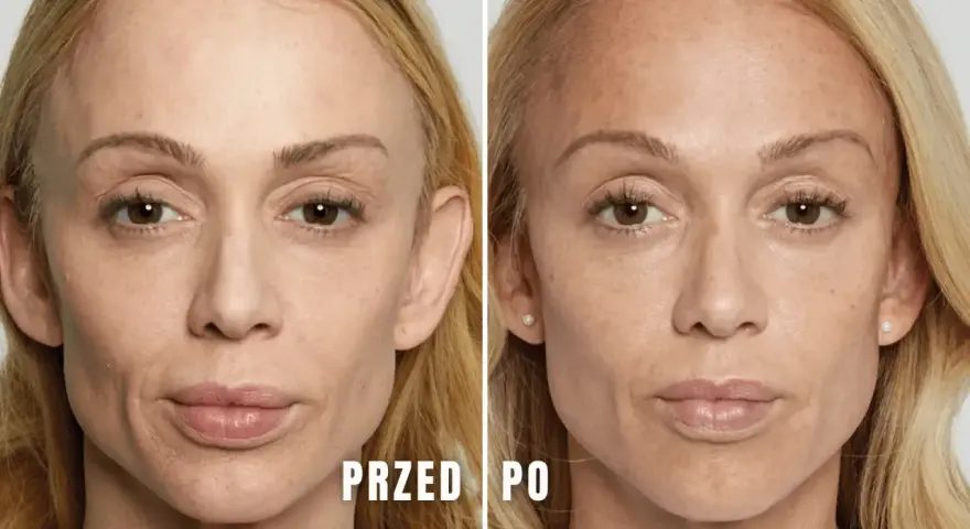 Przed i po zabiegu z użyciem polikaprolakton stymulator. Skóra twarzy wygładzona, z widoczną poprawą objętości i elastyczności.