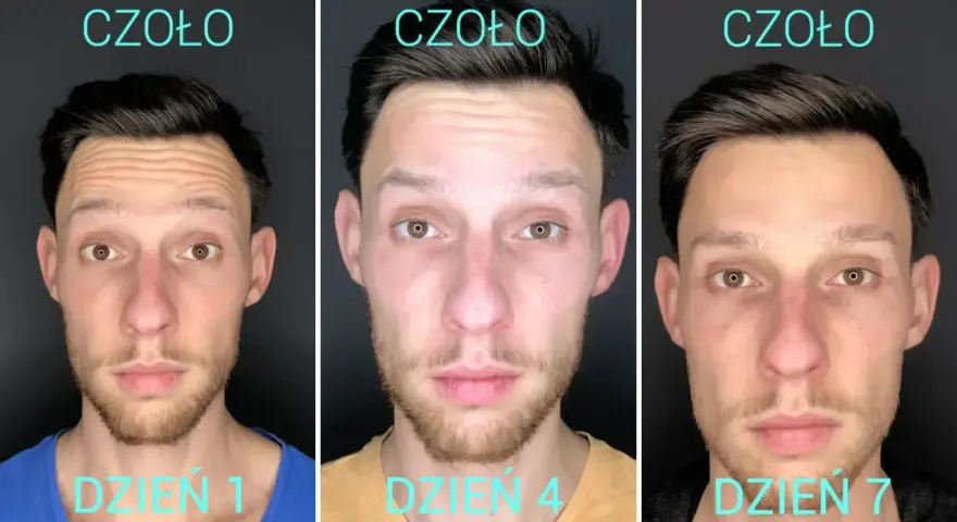 Efekt botoksu na zmarszczki palacza. Czoło mężczyzny dzień po dniu: dzień 1, dzień 4, dzień 7. Zmarszczki stają się mniej widoczne.