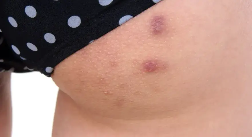 Skóra na udach z widocznymi krostami i przebarwieniami, częściowo zakryta przez czarne majtki w białe kropki.
