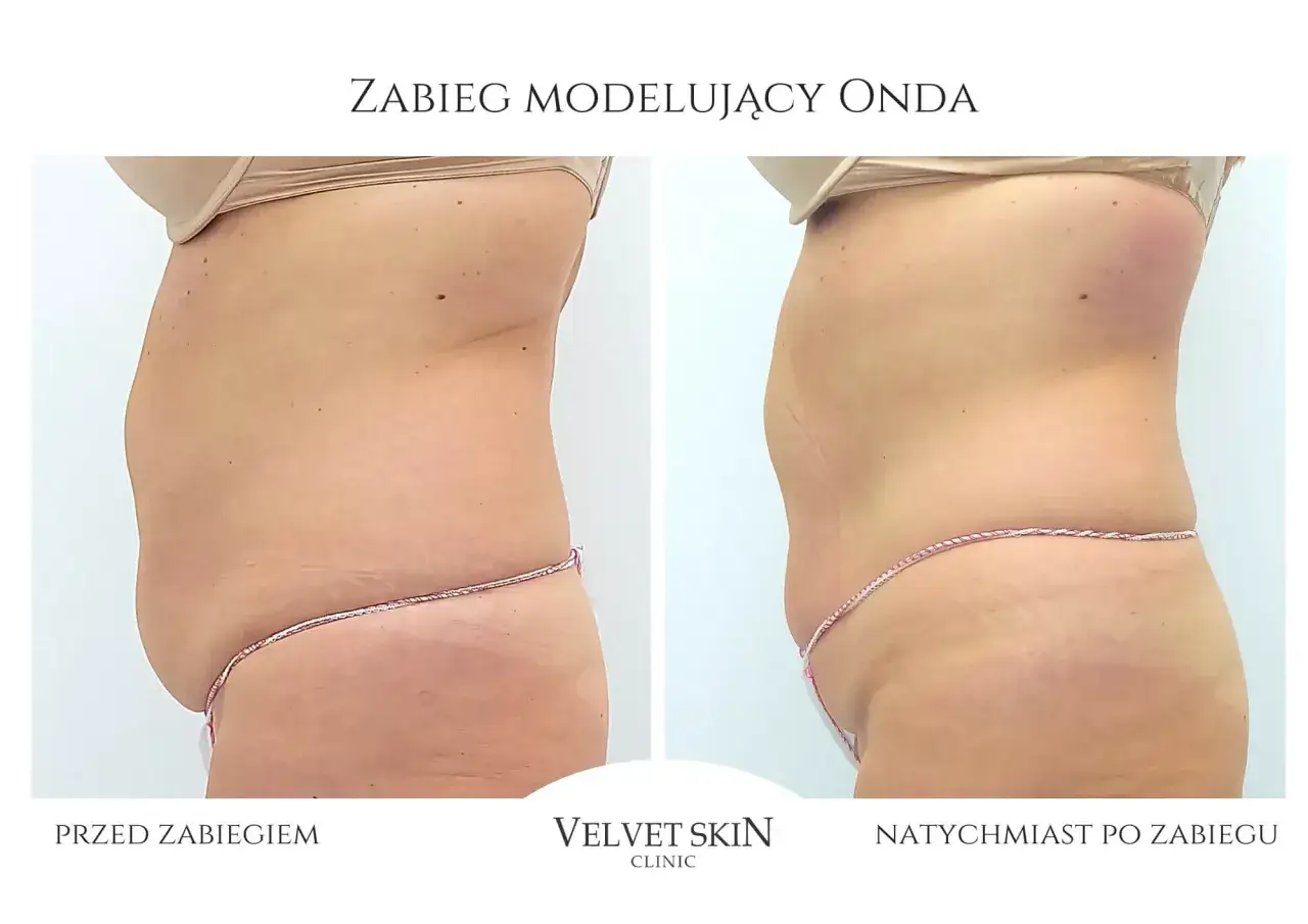 Porównanie sylwetki przed i po zabiegu modelującym. Widoczne natychmiastowe efekty onda, redukcja obwodu brzucha.
